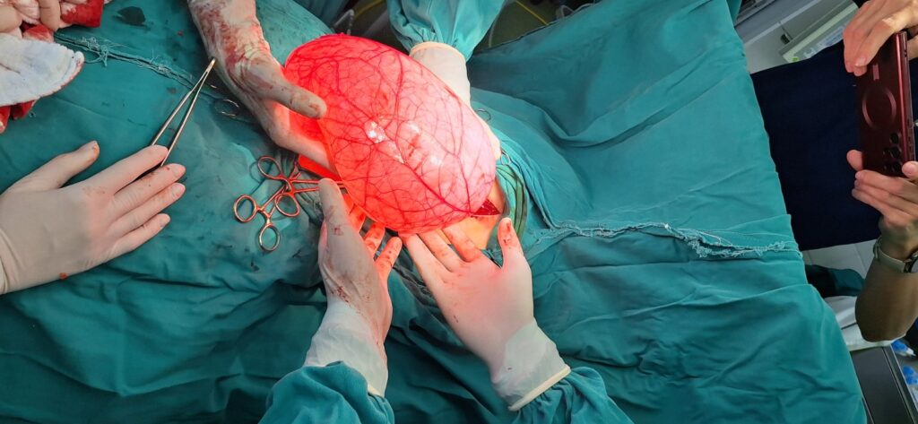 foto izvor Zdravstveni centar Valjevo tumor 4kg 06 2025