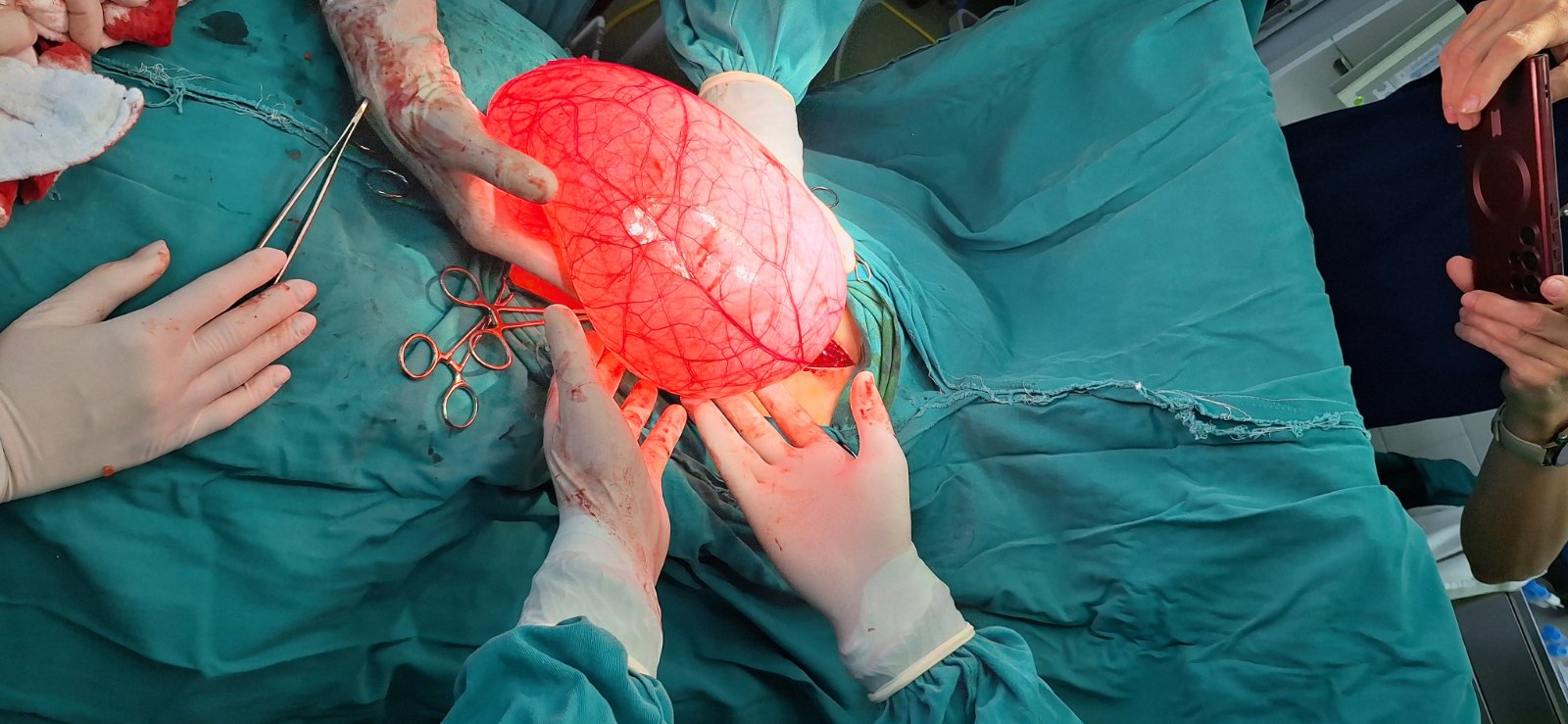 foto izvor Zdravstveni centar Valjevo tumor 4kg 06 2025